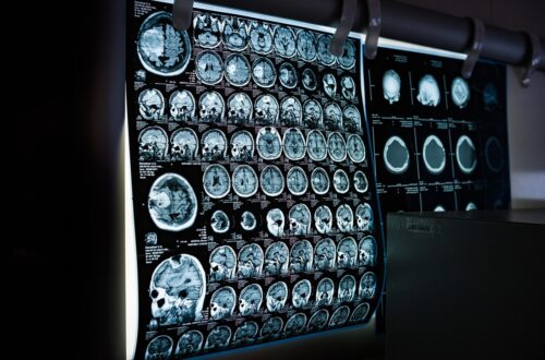 Два роки невідомої хвороби: у жінки діагностували пухлину мозку